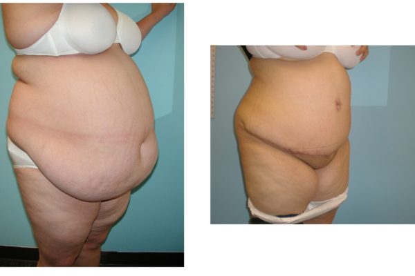 Very large woman before after Panniculectomy