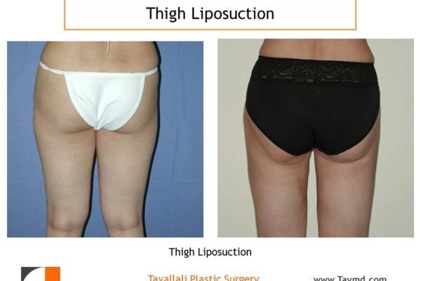 Inner thigh lipo before after