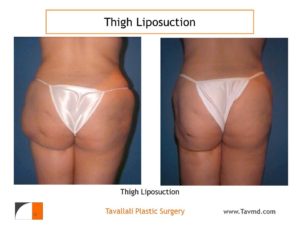 Liposuction hips and buttocks after deformity