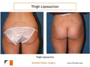 Outer Thigh liposuction surgery before after Virginia