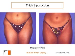 Hip and Thigh liposuction surgery before after Virginia