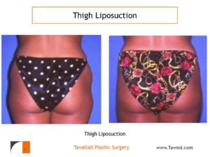 Hip and Thigh liposuction surgery before after Virginia