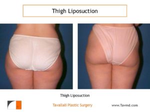 Outer Thigh liposuction surgery before after Virginia