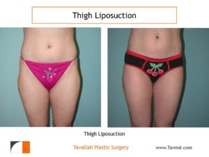 Thigh liposuction surgery before after Virginia in thin woman