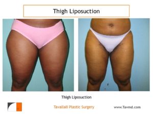 Thigh liposuction surgery before after Virginia