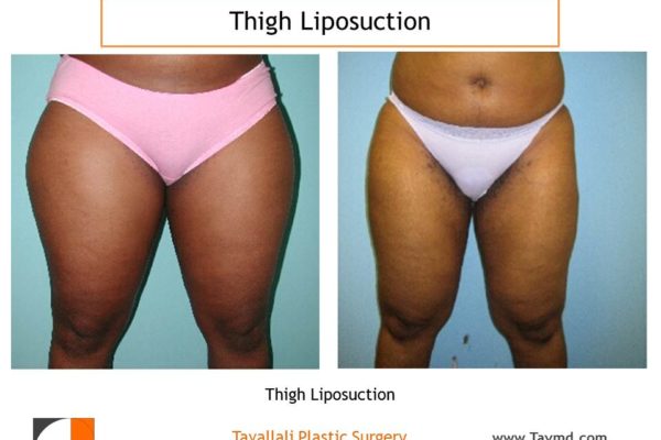 Thigh liposuction surgery before after Virginia