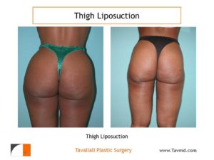Outer and inner thigh liposuction surgery result Virginia