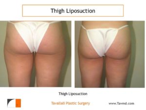 Inner Thigh liposuction surgery result Virginia