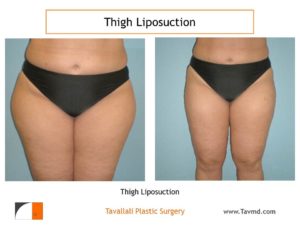 Thigh liposuction surgery Virginia