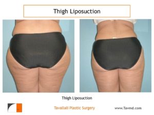 Outer Thigh liposuction surgery Virginia