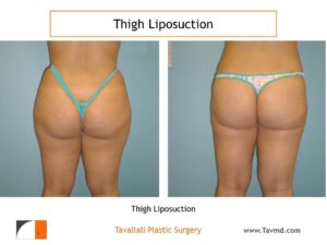 Thigh liposuction surgery Virginia back view