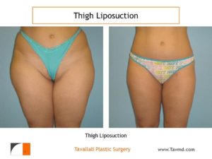 Thigh liposuction surgery Virginia
