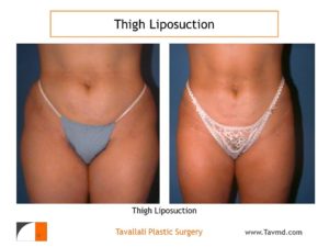 Liposuction outer thighs and hips