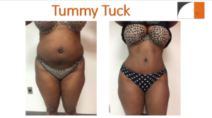 Tummy tuck abdominoplasty before& after Vienna VA