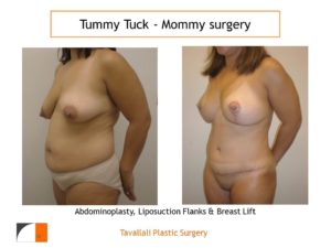 Woman with breast lift and tummy tuck