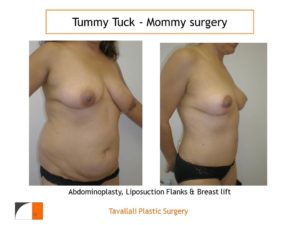 Mommy Surgery Tummy tuck abdominoplasty and Breast lift result