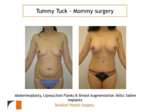 Mommy Surgery Tummy tuck abdominoplasty and Breast augmentation with 360 cc saline implant