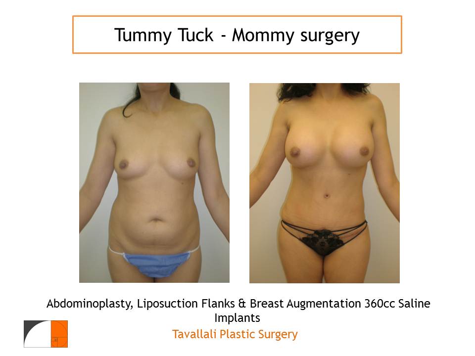 Mommy Surgery after weight loss