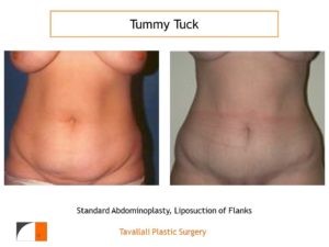 before after tummy tuck abdominoplasty surgery in Northern VA