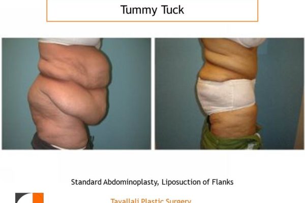 Obese woman before and after tummy tuck
