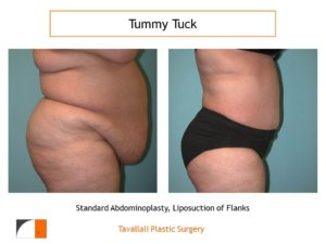 Large woman before after tummy tuck