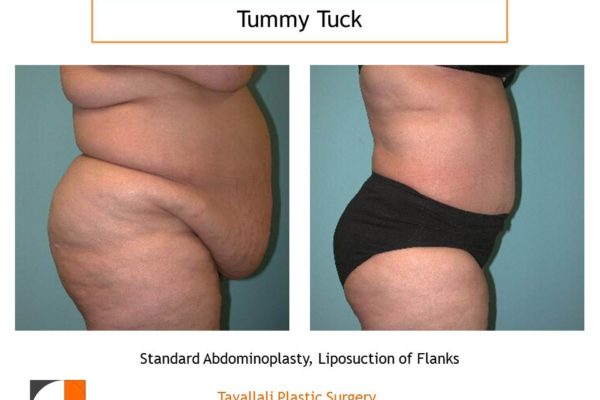 Large woman before after tummy tuck