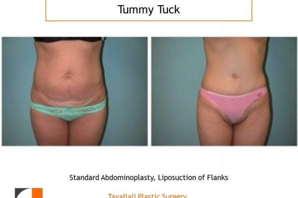 Thin woman before after tummy tuck abdominoplasty surgery Virgnia