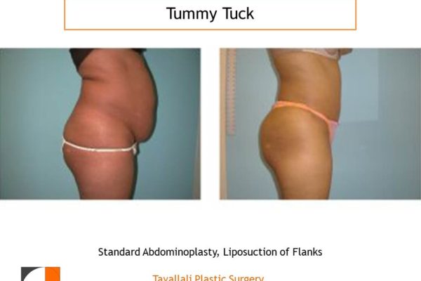 Before & after tummy tuck abdominoplasty surgery in Tyson's corner