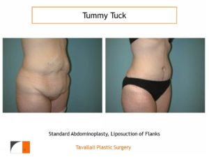 Before & after tummy tuck abdominoplasty surgery with fleur de lys incision Tyson's corner