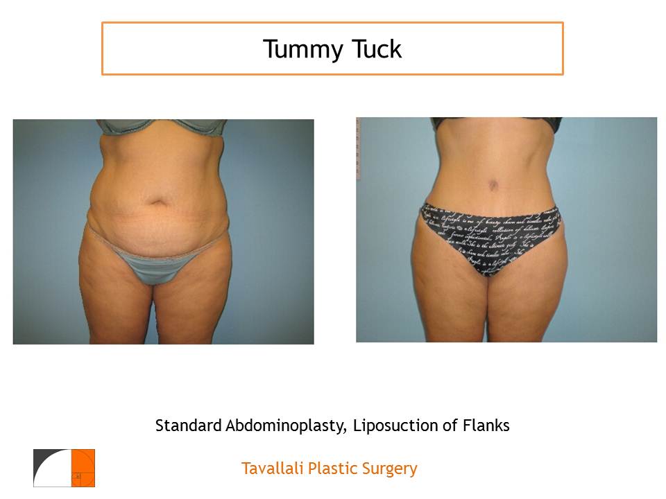 Bulges After Abdominoplasty-Tummy Tuck