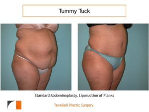 Large woman before after tummy tuck abdominoplasty VA