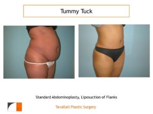 Standard Tummy tuck abdominoplasty oblique view
