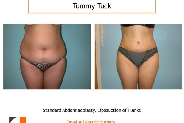 Full Tummy tuck abdominoplasty before after