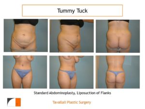 Front and back Full Tummy tuck abdominoplasty before after