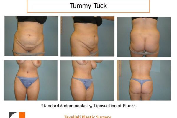 Front and back Full Tummy tuck abdominoplasty before after