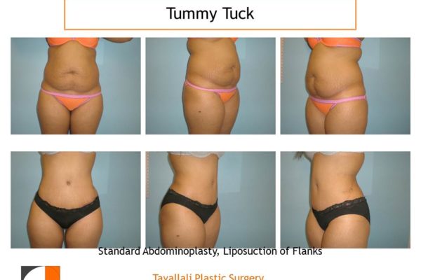Full Tummy tuck abdominoplasty multiple views before after
