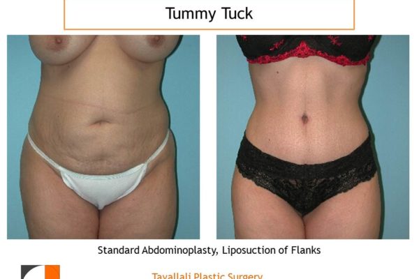 Small woman before after tummy tuck abdominoplasty surgery