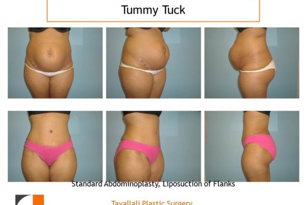 Multiple views full tummy tuck abdominoplasty