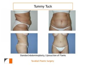 Full Tummy tuck abdominoplasty before after results