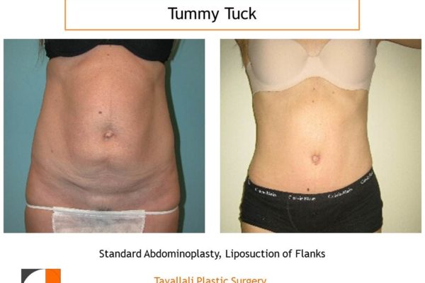 Thin woman before after tummy tuck abdominoplasty surgery