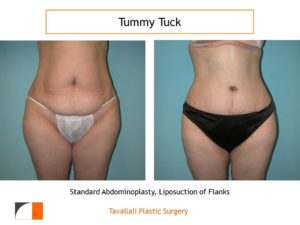 Woman before after tummy tuck abdominoplasty surgery