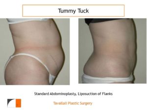 Trunk woman before after tummy tuck abdominoplasty surgery in Northern VA
