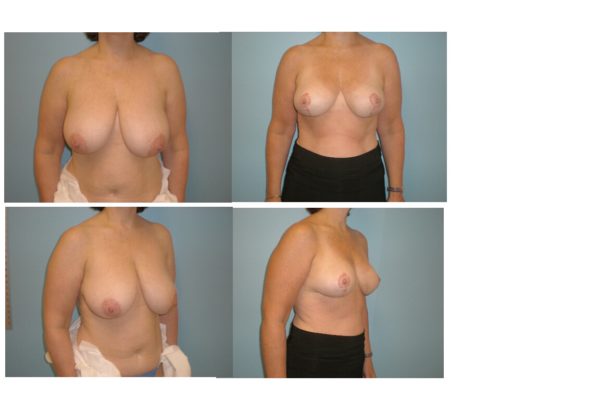 Breast reduction result with vertical mammoplasty before after