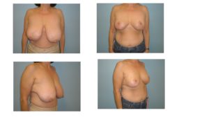 Results of breast reduction surgery northern VA