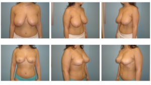 Results of breast reduction surgery northern VA