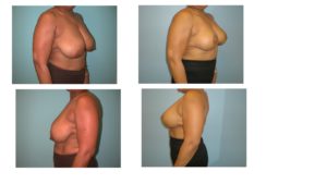 Breast reduction before after