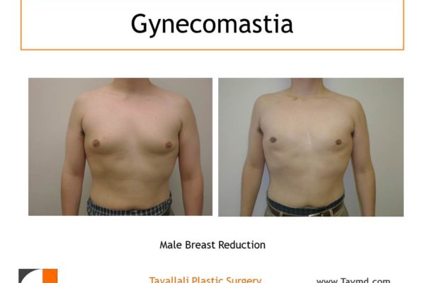 Gynecomastia Before & After
