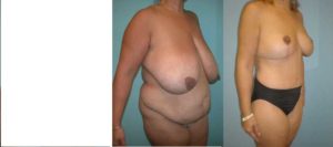 Mommy surgery abdominoplasty & breast reduction Vienna VA