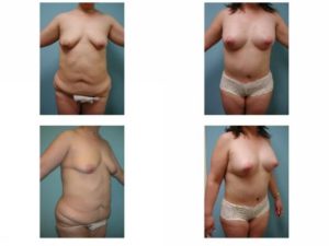 Mommy Surgery Tummy tuck abdominoplasty and Breast augmentation with implant before after
