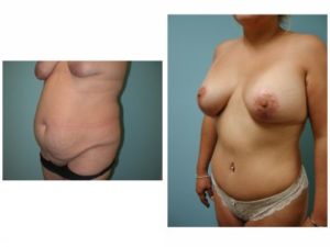 Mommy Surgery Tummy tuck abdominoplasty and Breast lift and augmentation with implant